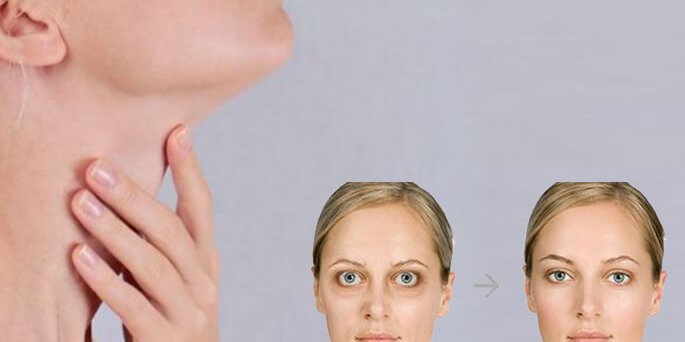 Tiroidle ilişkili göz hastalığı