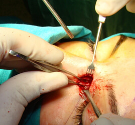 External Dakriyosistorinostomi Ameliyatı