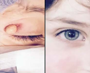 Dermoid ve Epidermoid Kistler