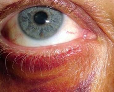 Göz Kapağı Yaralanması