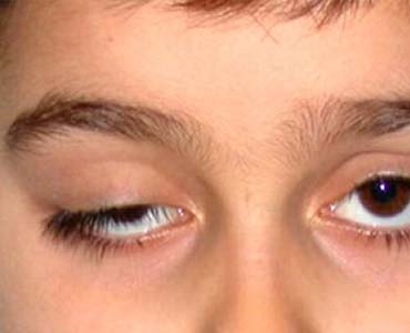 Göz Kapağı Düşüklüğü - Ptozis