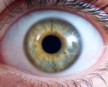 Göz Kapaklarının Açık Olması - Kapak Retraksiyonu