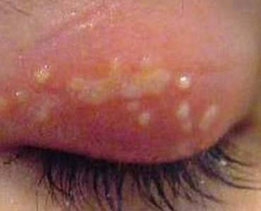 Yara İzi Dokusu (Nedbe)