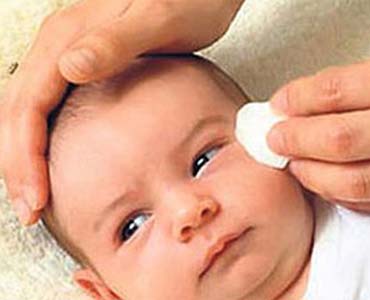 Bebeklerde Göz Sulanması - Doğumsal Dakriyostenoz