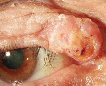 Göz Kapağı Tümörleri