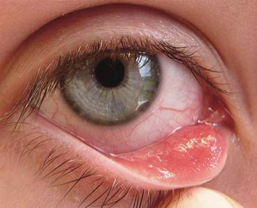 Göz Kapaklarının Dışa Dönmesi - Ektropion