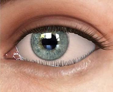 Göz Kapaklarının İçe Dönmesi - Entropion