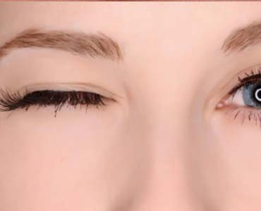 Göz Kapaklarının İstemsiz Sıkılması - Blefarospazm